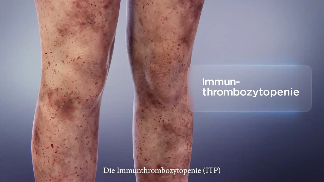 Immunthrombozytopenie