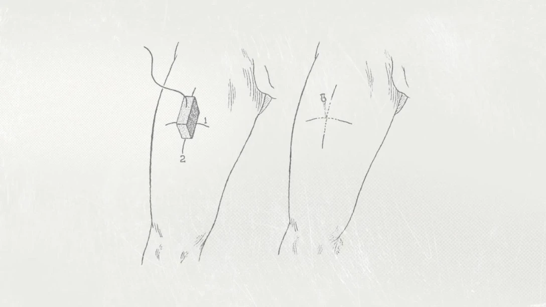 Injection echography - NL