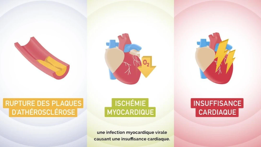 01_MONTAGE SANOFI_FR_ST_3