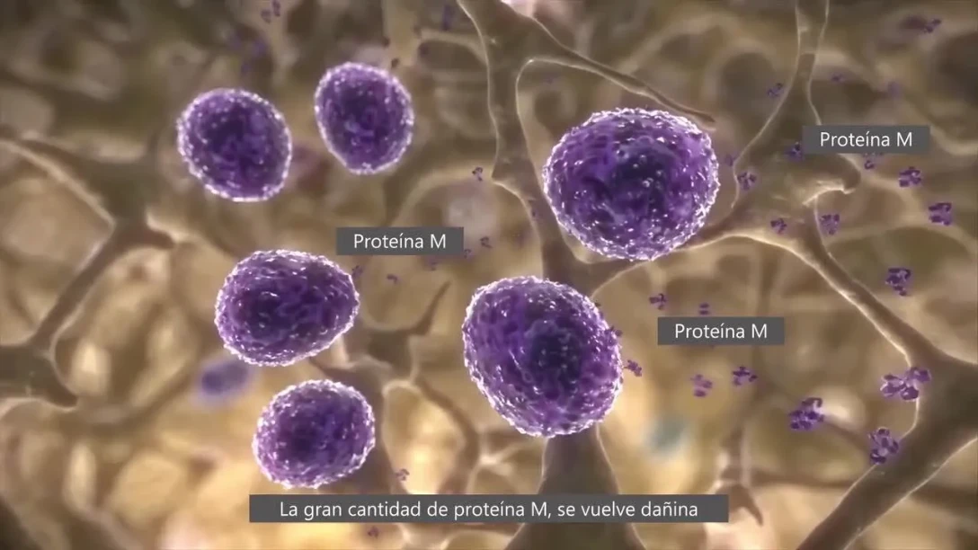 ¿Qué es el Mieloma Múltiple?