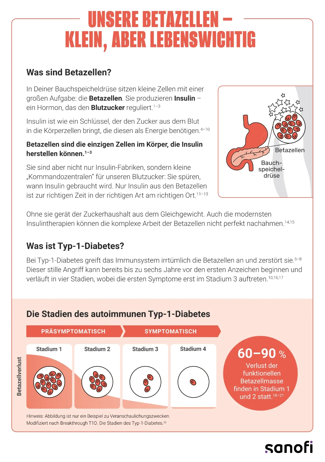 Die Grafik zeigt, was Betazellen sind, welche Rolle sie bei der Insulinproduktion spielen und wie sie bei Typ-1-Diabetes schrittweise zerstört werden.