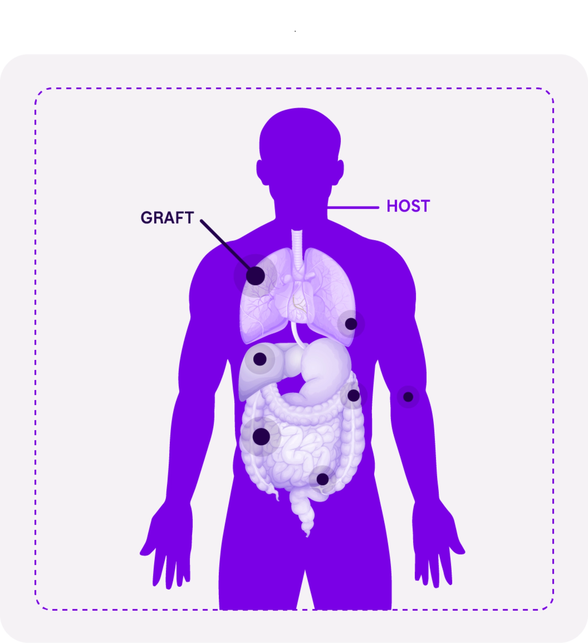 Overview of GvHD