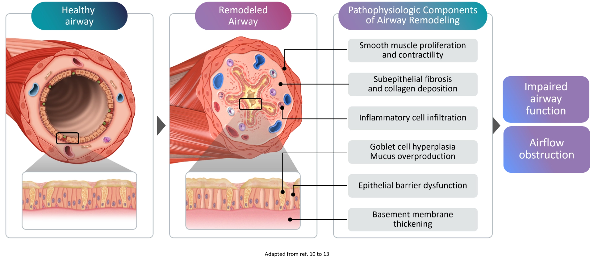 Airway remodeling in asthma: Why targeting IL-4 and IL-13 matters ...