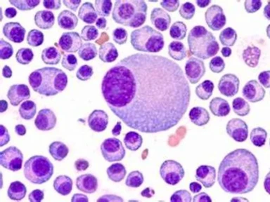 Lenalidomide Refractory Patients