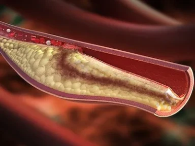 Risk factors of lower extremity DVT in patients undergone gynecological laparoscopic surgery