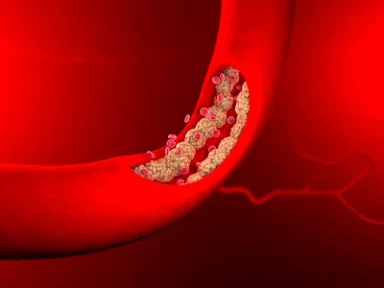 The European experience: Swedeheart and AIFA registries