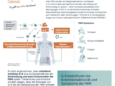 Kevzara® - Pathophysiologie der PMR und Rolle der IL-6-Ri