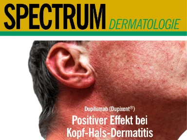 Positiver Effekt bei Kopf-Hals-Dermatitis