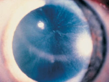 Cutting Edge Decision Making & Risk Assessment in Severe Asthma