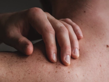 Understanding Atopic dermatitis