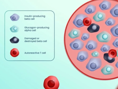 Understanding the type 1 diabetes autoimmune process