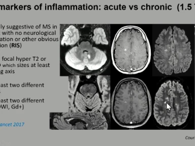 MS Progressie en neuroradiologie