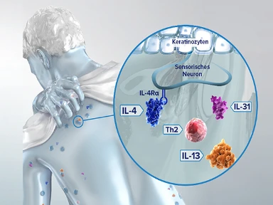 Prurigo nodularis - The story of a disease