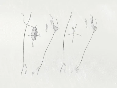 Injectietechniek onder echografie