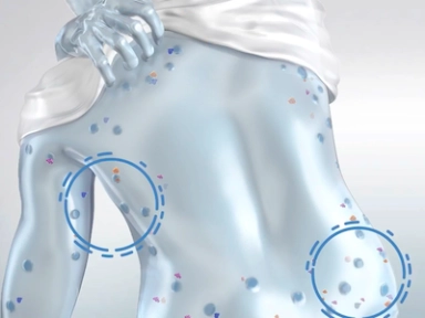 Mechanism of Prurigo Nodularis Disease