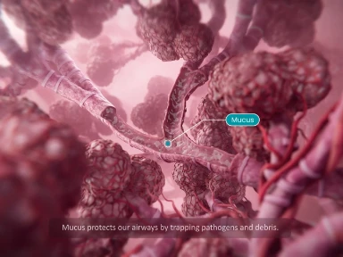Understanding Airway Obstruction: The Role of Mucus Plugging in Asthmatic Disease