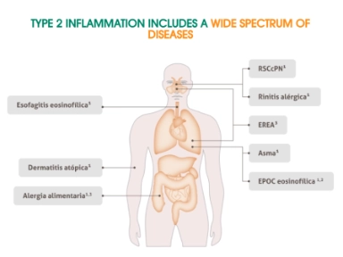 La Inflamación Tipo 2 Incluye Un Amplio Espectro De Enfermedades