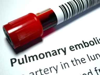Masivní PE v oblastní nemocnici imitující infarkt myokardu