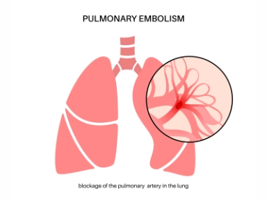 Plicní embolie u mladé ženy, jak to chodí v běžné praxi