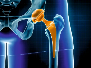 Záznam video přednášky Profylaxe VTE u ortopedických pacientů