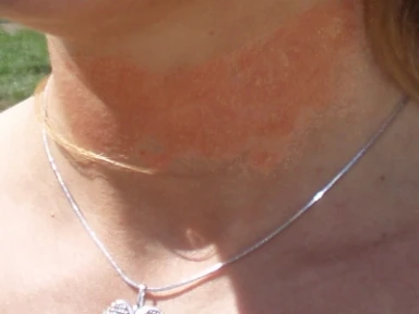 ADCT: nástroj ke zvládání atopické dermatitidy (pro HCP)