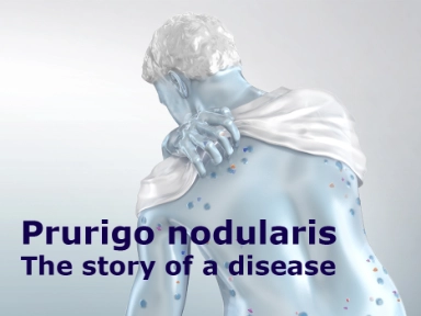 Prurigo nodularis the story of a disease