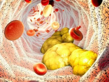 Sanofi RWE - Επίδραση των PCSK9i στα καρδιαγγειακά αποτελέσματα σε ασθενείς με ASCVD χωρίς προηγούμενο MACE