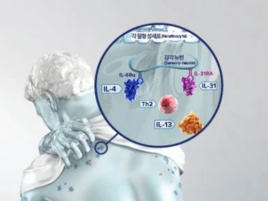 결절성 가려움 발진(양진)과 제2형 염증