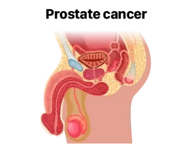 Oncology 전립선암 질환정보