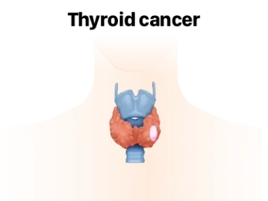 Oncology 갑상선암 질환정보