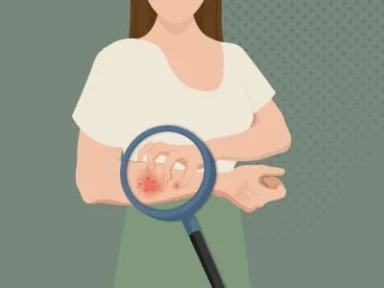 아토피피부염 이해하기