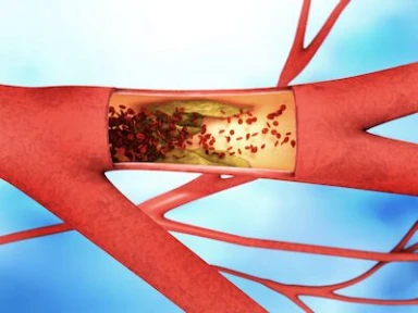  Post-Infarctus de Myocarde: ❤️ l’importance de réduire le taux du LDL-C