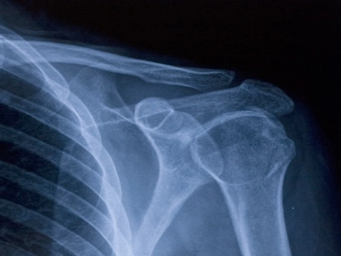 Hilano G-F 20: Infiltración en hombro