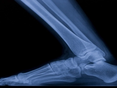 Hilano G-F 20: Infiltración en tobillo