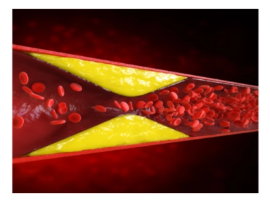 Ventajas clínicas de enoxaparina: Estudio ENOXACAN I