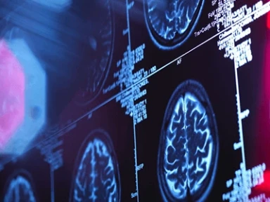 High-risk TIA patients under treated with Clopidogrel-Aspirin in emergency setting