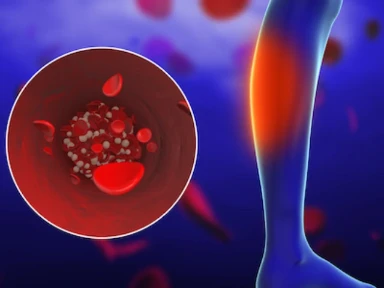 Approach for patients with peripheral artery disease (PAD) + T2DM: focus on LDL-C control