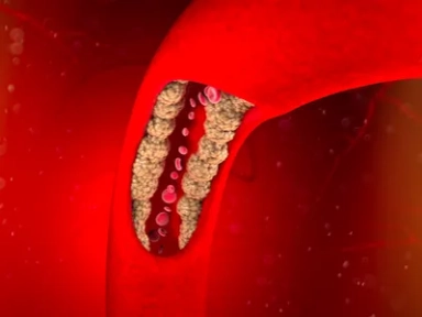 Evaluation of lipid management following ACS