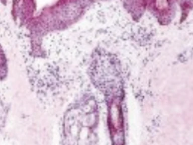 About Type 2 Inflammation – Atopic Dermatitis