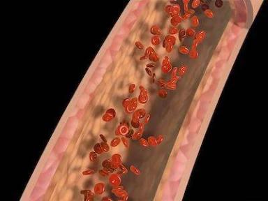 PCSK9 Inhibitors in Cardiovascular Disease