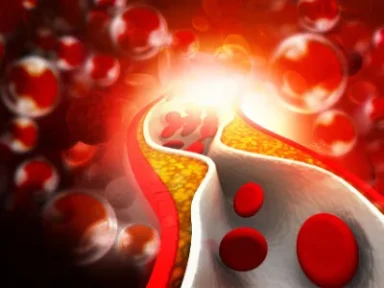 Metaboliczne czynniki ryzyka i wpływ alirokumabu na zdarzenia sercowo-naczyniowe po ostrym zespole wieńcowym: Analiza post hoc badania Odyssey Outcomes