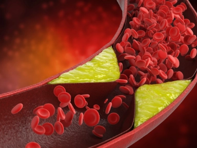 Kontrola poziomu lipidów w Europie: badanie SANTORINI