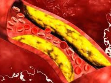 Różnice we wdrażaniu zalecanej w wytycznych terapii obniżającej stężenie lipidów