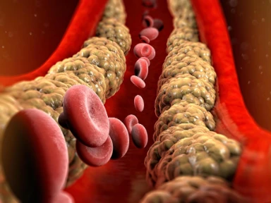 Stopniowa, ustrukturyzowana strategia obniżania poziomu cholesterolu LDL-C u pacjentów po OZW