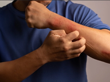 Niewidoczne Obciążenia: Jak kumulatywne upośledzenie przebiegu życia (CLCI) wpływa na pacjentów z umiarkowanym do ciężkiego atopowym zapaleniem skóry (AZS)?