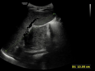 Opis przypadku 11 letniej dziewczynki z chorobą Gauchera