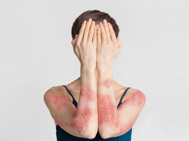 Ukryty wpływ skumulowanego upośledzenia przebiegu życia (CLCI) w dermatologii: Wprowadzenie