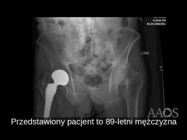 Nowoczesne podejście chirurgiczne do leczenia złamania szyjki kości udowej u osób starszych.