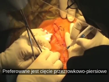 Całkowita alloplastyka stawu ramiennego