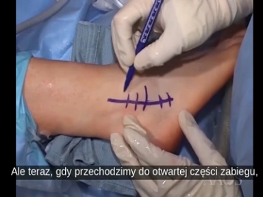 Wzmocniona rekonstrukcja więzadła bocznego stawu skokowego